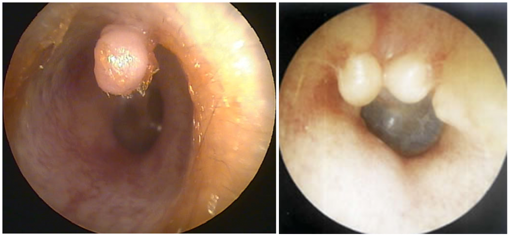 اگزوستوسیز و اوستئوماز دو عارضه‌ای که درون مجرای گوش رخ می‌ده