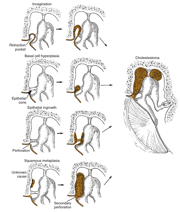 نمایی از تشکیل کلستئاتوما در اثر به داخل کشیده شدن پرده‌ی گوش و تجمع بافت‌های مرده‌ی پوست که موجب فرسایش استخوانچه‌ها و بافت‌های استخوانی اطراف آن‌ها می‌شود.