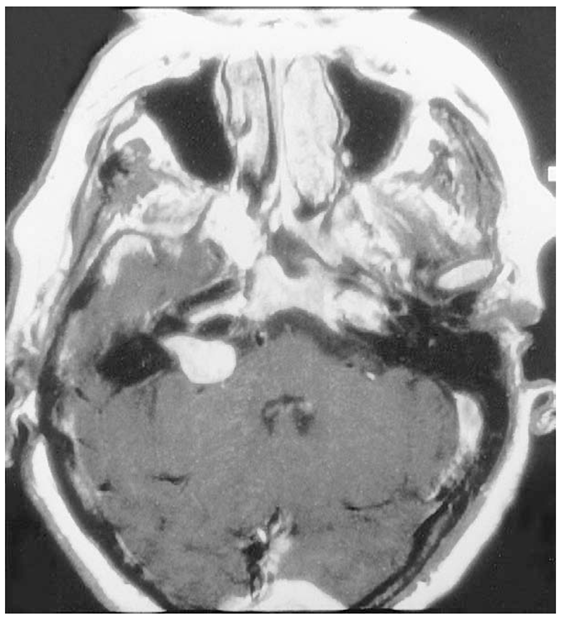 نمایی از تومور اکوستیک که درون مجرای شنوایی داخلی رخ داده است.