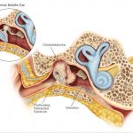 تومورهای مجرای شنوایی داخلی و زاویه‌ی پلی مخچه‌ای