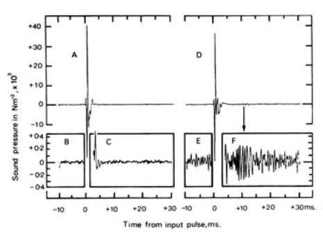 نمایی از اولین ثبت گسیل صوتی گوش که توسط پروفسور دیوید کمپ در سال 1978 انجام شد.