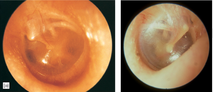 دو نمونه از پرده‌ی گوش سالم و نرمال که متعلق به گوش راست و چپ می‌باشند