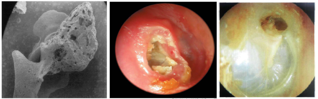 رتراکشن عمیق پرده‌ی گوش منجر به کلستئاتوما می‌شود