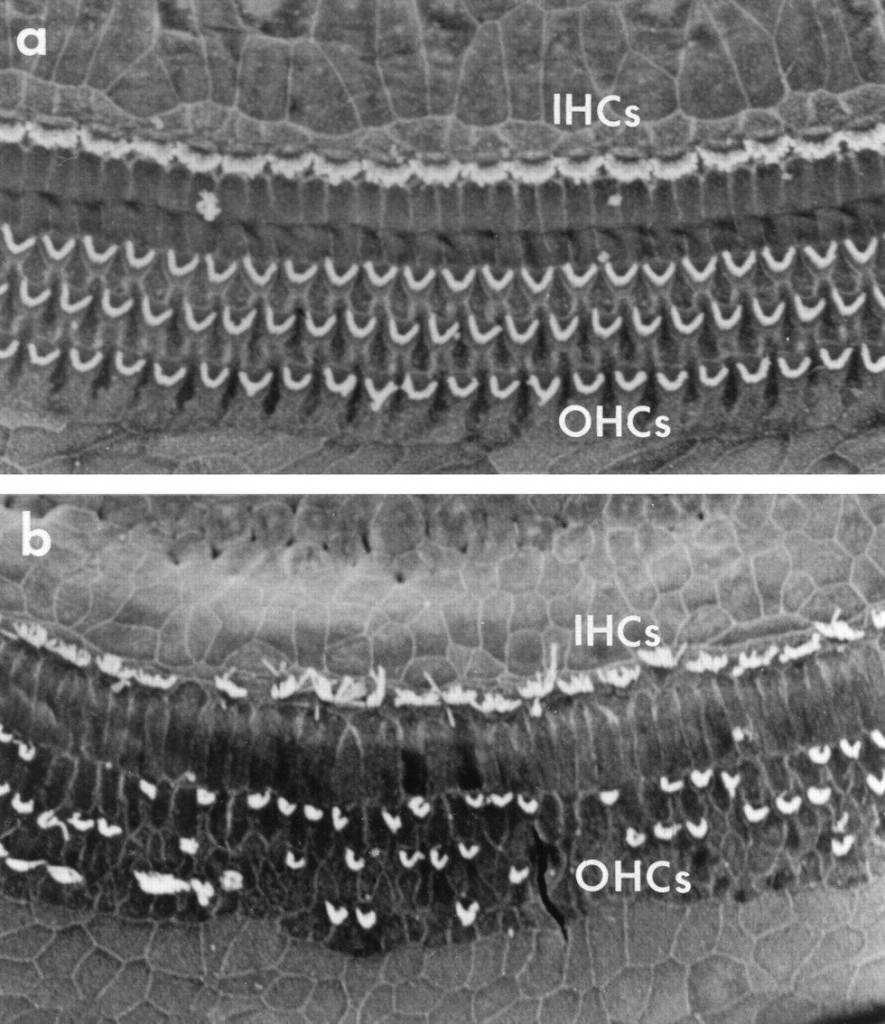 تصویری از نمای فوقانی سلول‌های مویی خارجی (OHCs) و سلول‌های مویی داخلی (IHCs) در گوش سالم (تصویر بالا) و گوش آسیب دیده (تصویر پایین). همچنان که در تصویر بالا مشاهده می‌شود،