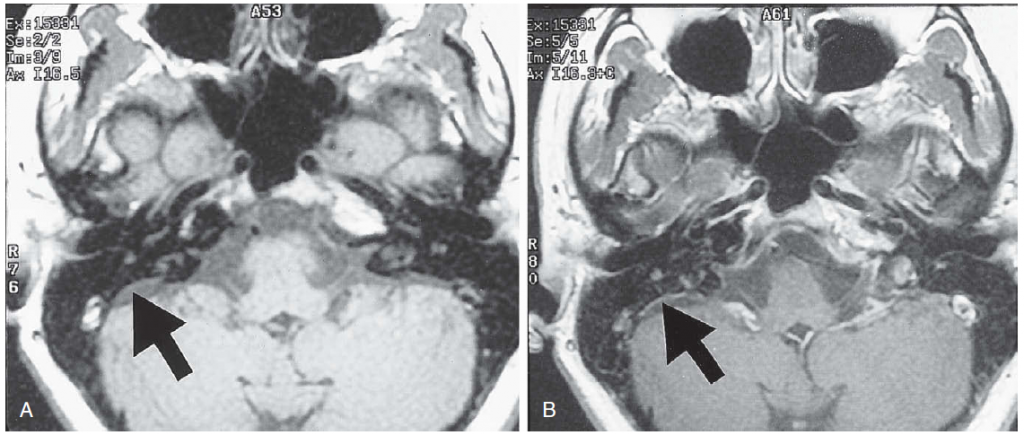 نمایی از MRI دو بیماری که کیسه‌ی آندولنفاتیک آن‌ها در اثر تولید زیاد مایع آندولنف ورم و باد کرده است که با علات پیکان نشان داده شده است.