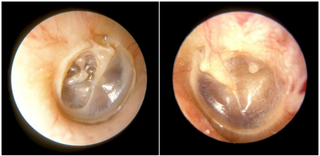 تصویر سمت راست، پرده‌ی گوش چپ را نشان می‌دهد که کاملا نرمال و سالم است