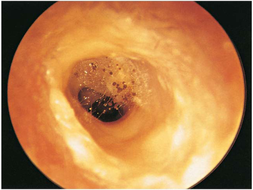 نمونه‌ای از اوتیت خارجی قارچی گوش که معمولا این نوع اوتیت به ندرت رخ میدهد