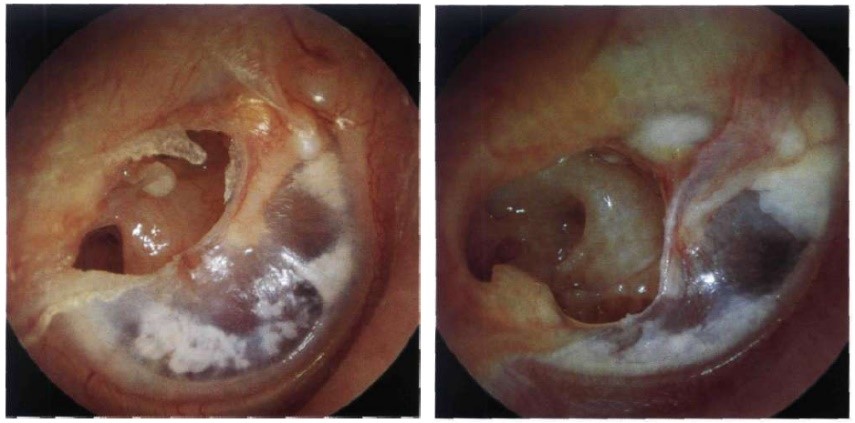 دو نمونه از پارگی پرده‌ی گوش در اثر اوتیت حاد گوش میانی که منتهی به تخلیه‌ی چرک و عفونت از فضای گوش میانی به بیرون می‌شود.