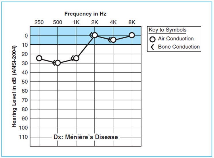 کم شنوایی در فرکانس‌های پایین در بسیاری از بیماران منیری در اوایل بیماری مشاهده می‌شود 